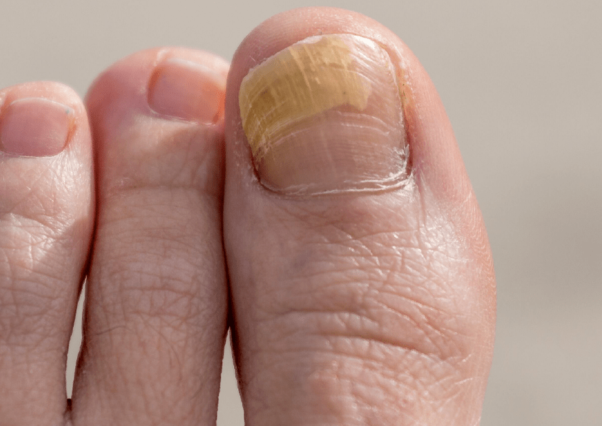 champignon sur l'ongle du gros orteil