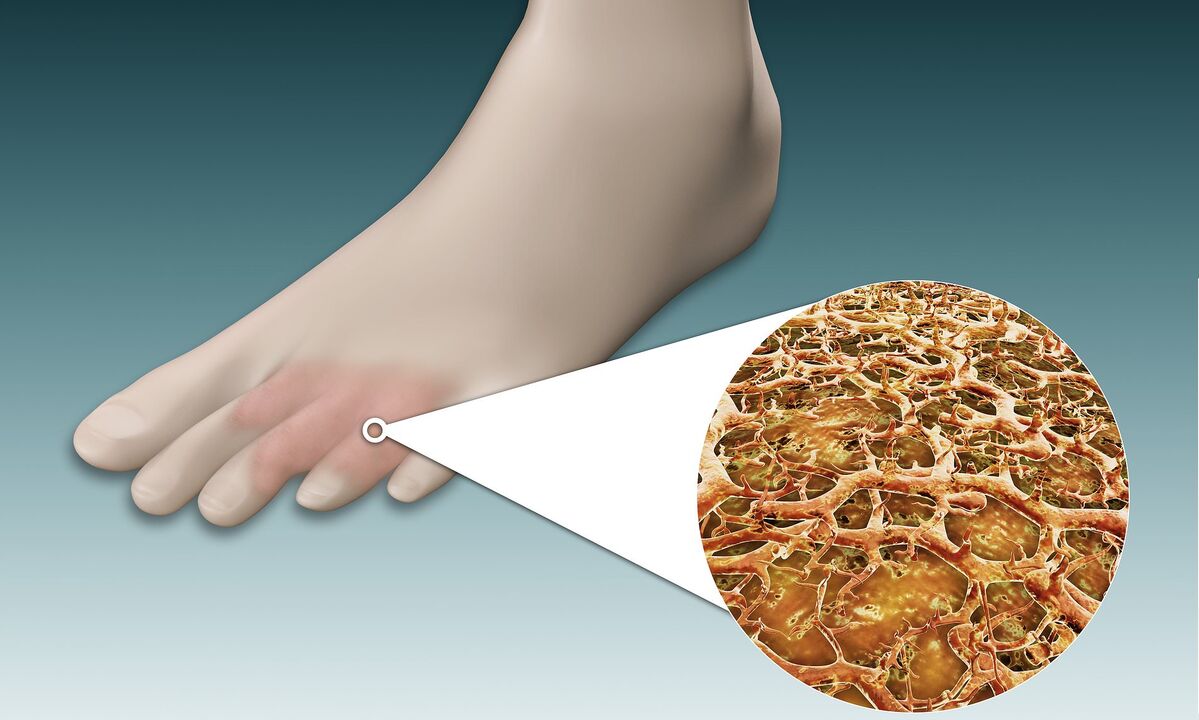 spores fongiques sur les pieds
