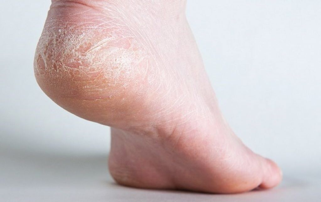 champignon sur la peau des pieds